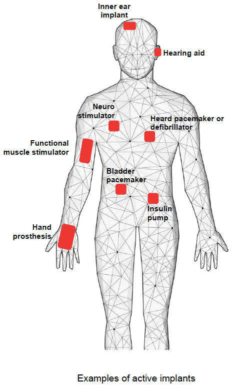 examples-of-active-implants